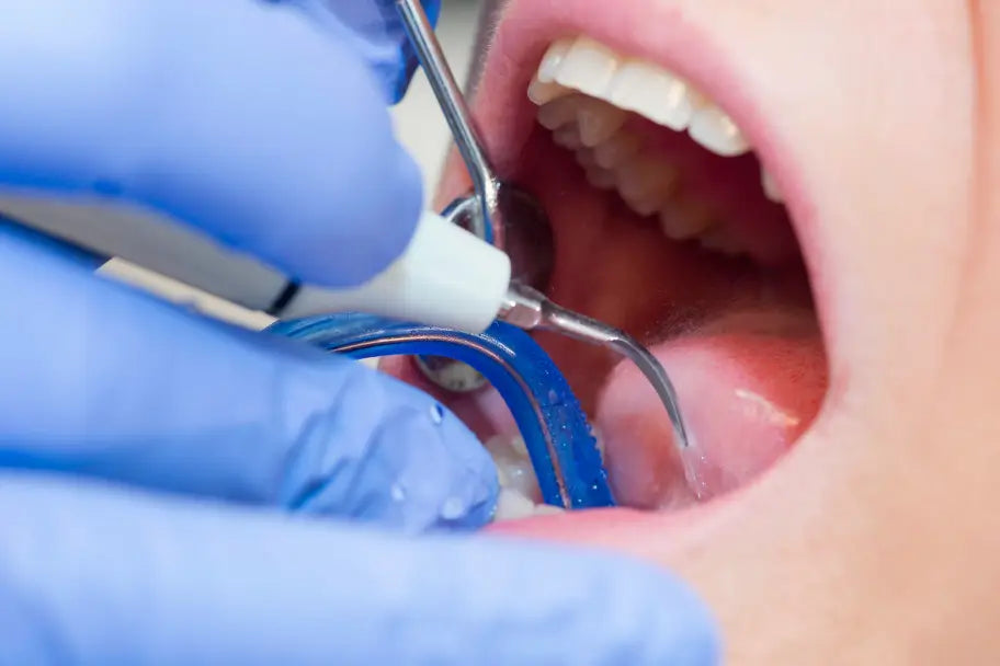 How to Remove Hard Tartar